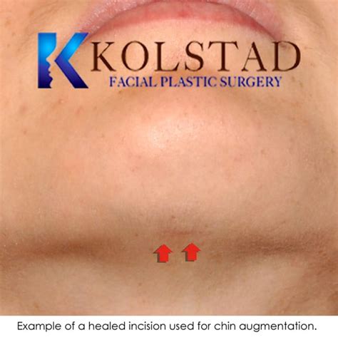 Chin Augmentation Before And After Gallery Dr Kolstad San Diego