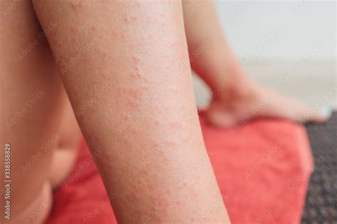 Foto Stock Dermatitis Herpetiformis Skin Rash In A Woman With Nonceliac Gluten Sensitivity