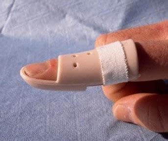 Mallet Finger Causes Symptoms Treatment Action Rehab