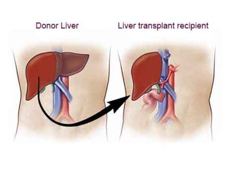 everything you need to know about liver transplant by dr shailender lalwani published story