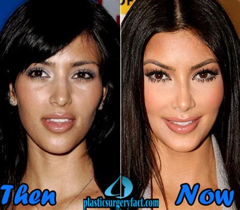 Celebrity Plastic Surgery Before After 2016 Shocking