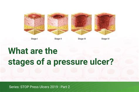What Are The Stages Of A Pressure Ulcer O Neill Healthcare