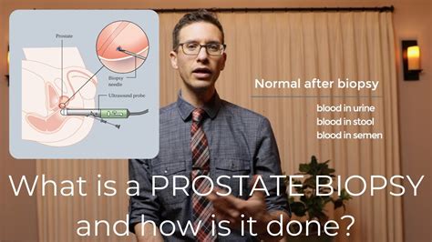 Prostate Biopsy Procedure Explained By Urologist Youtube