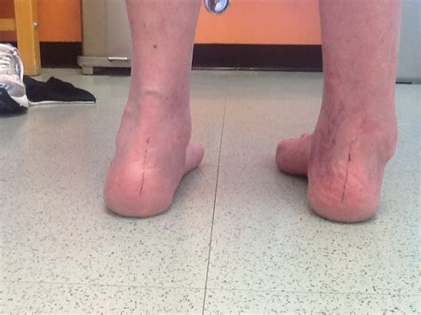 Foot And Ankle Problems By Dr Richard Blake Pre Operative Discussion Prior To Resurgery To A