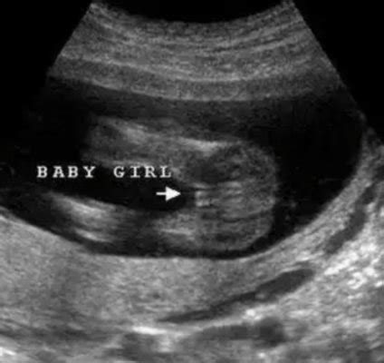 Anyone Had Wrong Gender On Ultrasound BabyCenter