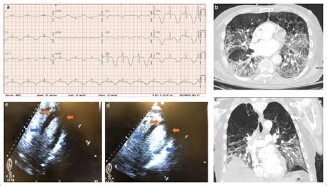 Atypical Takotsubo Cardiomyopathy In Covid The American Journal Of