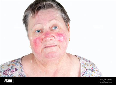Unhappy Elderly Woman With Skin Condition Rosacea Characterized By