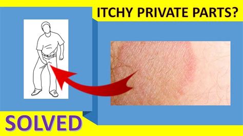 Blackheads are basically small black bumps on your body. How To Cure Itching Near Private Parts | Itchy Groin Area ...