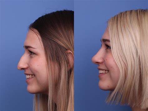 Rhinoplasty Before And After Things A Nose Job Can Achieve Hobgood Facial Plastic Surgery