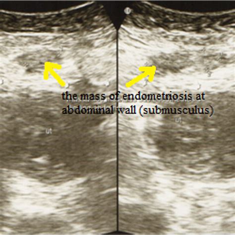 Pdf Extrapelvic Endometriosis In Abdominal Wall Scar And Ppar Gamma