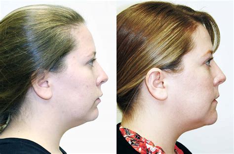 Lower Jaw And Chin Forward Corrective Jaw Surgery Dr Antipov