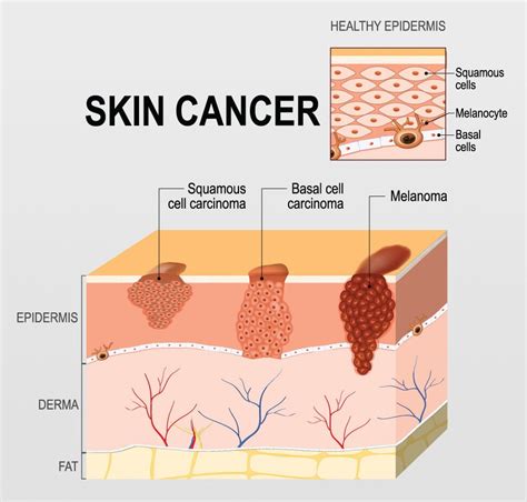 St Marys Regional Cancer Center Offers Tips To Protect You From Skin