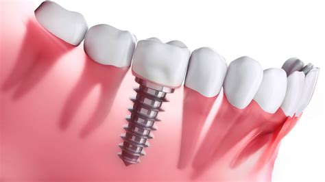 What To Expect During A Dental Implant Procedure And Its Advantages