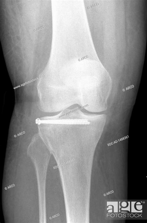 X Ray Image Of Patient After Tibial Plateau Fracture With 2 Screws