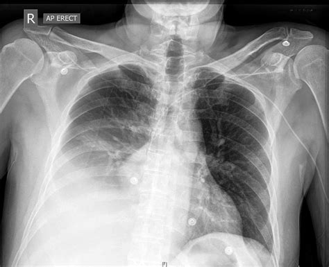 Picc Line Placement Chest X Ray Medschool