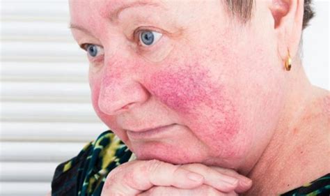 How To Treat Rosacea The 6 Things That Trigger Acne Rosacea Safe