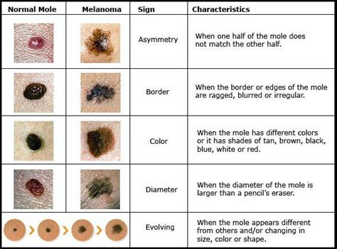 Dog Skin Cancer Black Spot Pictures Dog Skin Cancer Black Spot