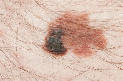 Skin Cancer Photograph By Dr P Marazzi Science Photo Library