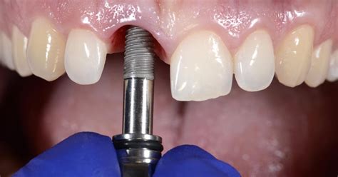 Clinica Dental Comas Qué son los impantes Dentales