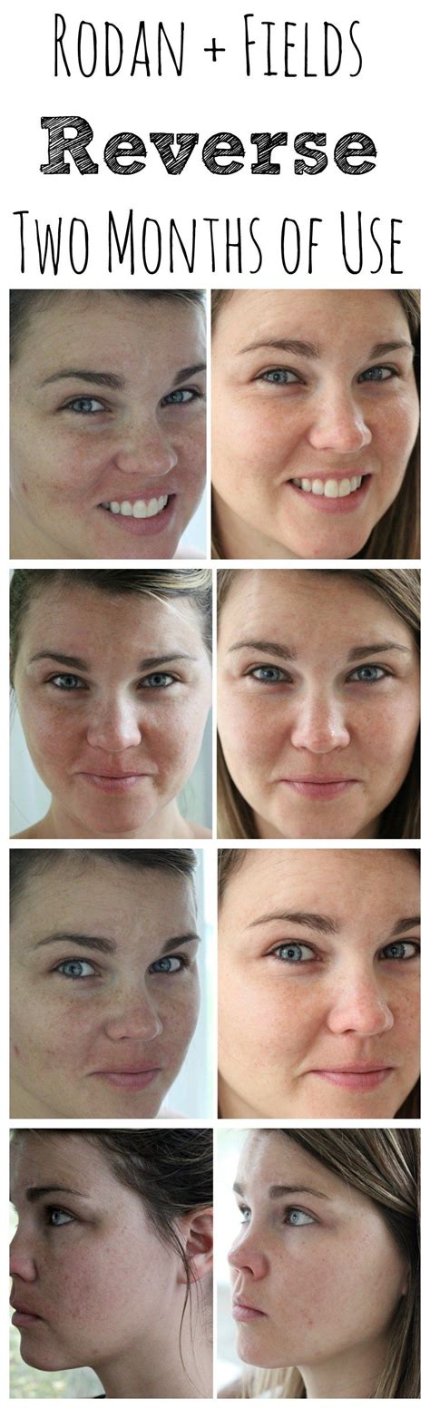 Rodan And Fields Before And After With The Reverse Regimen Rodan And