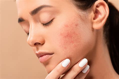 Acne Myskindoctor