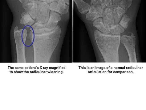Distal Radioulnar Joint X Ray