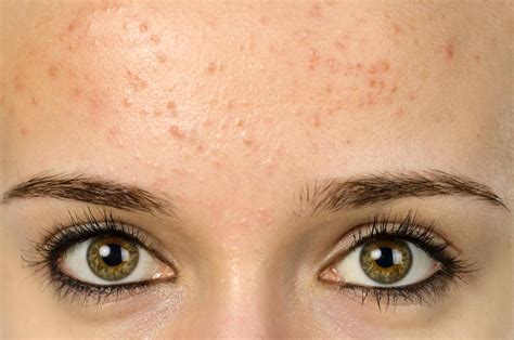 How To Get Rid Of Forehead Acne Naturally