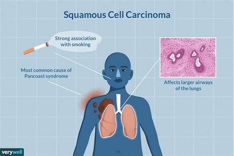 Squamous Cell Carcinoma Of The Lung Guide Causes Symptoms And My Xxx Hot Girl