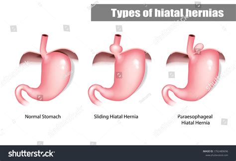 Types Hiatal Hernias Sliding And Paraesophageal Vector Image Sexiz Pix