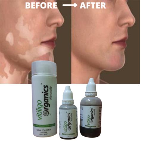 Vitiligo Organics Skin Lotion For White Spot Patches Repair