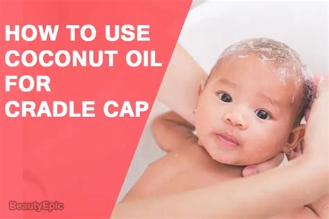 Coconut Oil For Cradle Cap Treatment How To Use