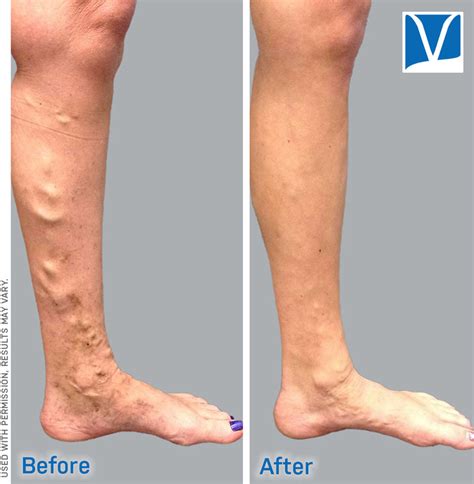 How Much Varicose Vein Treatment Costs Without Insurance