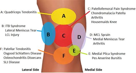 Anterior Knee Pain Diagnosis Chart This Knee Pain Injury Chart Helps