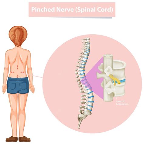 Free Vector Diagram Showing Pinched Nerve
