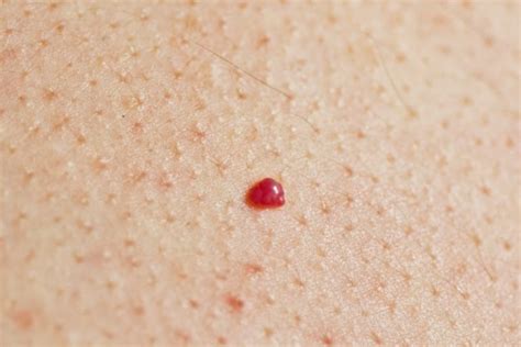 Cherry Angioma Causes Pictures Treatment And Prevention