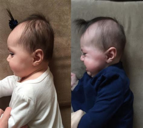 How To Fix Baby Flat Head At 4 Months