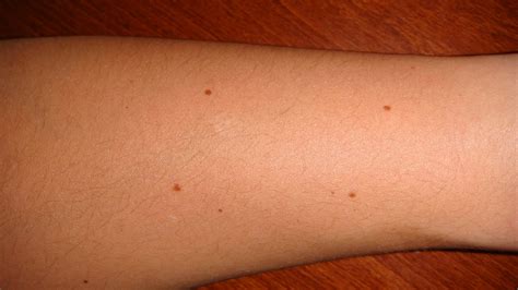 Photos Of Moles On Hand Arm And Leg ~ How To Remove Moles Warts Skin Tags Safely