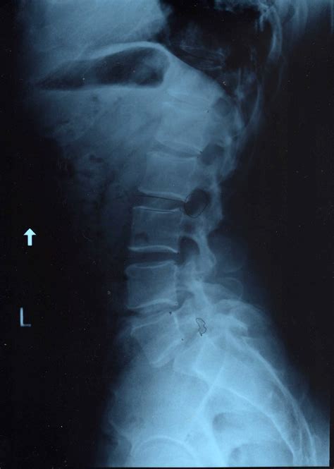 Xray Keith Spondylosis 1 Here Is An X Ray Of My L5 Ver Flickr