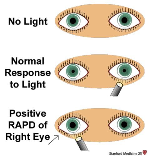 Pupil Reaction Chart