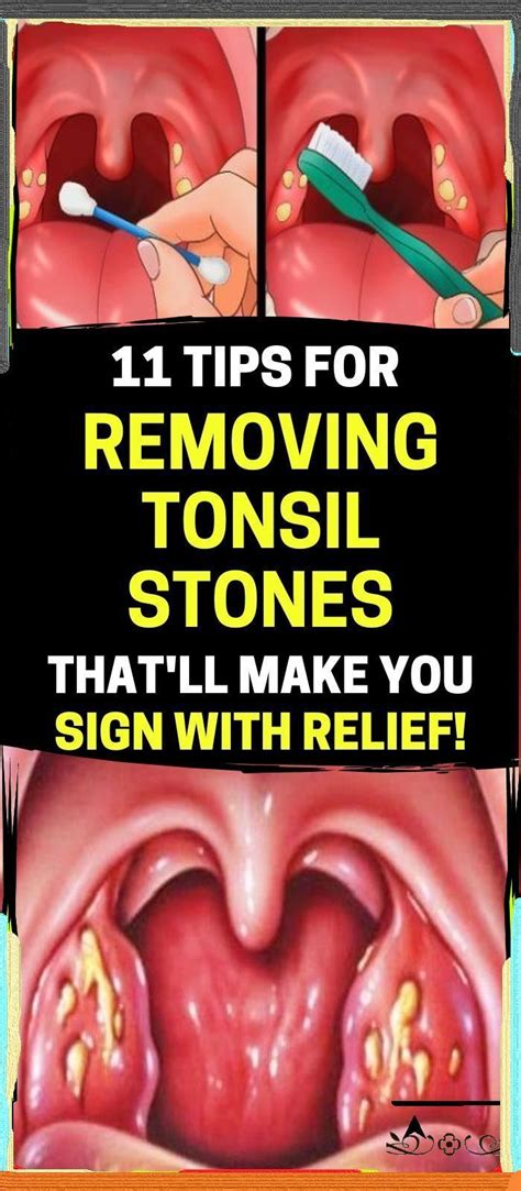 What Causes Tonsil Stones And How To Prevent Them