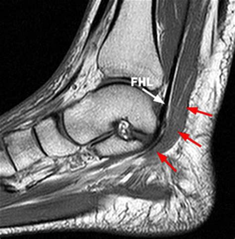 Magnetic resonance imaging (mri), with its multiplanar capabilities, superior soft tissue contrast, excellent spatial resolution, ability to image bone marrow, noninvasiveness, and lack… Accessory Muscles of the Ankle - Radsource