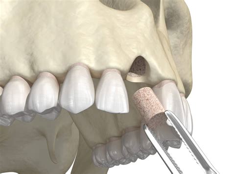 Celina Dentist Explains How Jawbone Grafting Prepares The Way For