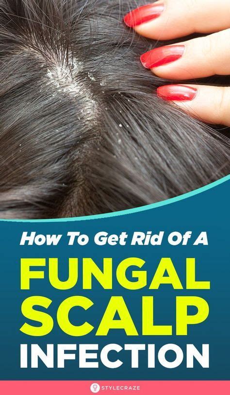 How To Get Rid Of Fungal Scalp Infection 8 Natural Remedies Dry