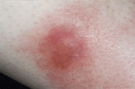 Erythema Nodosum What Are These Red Bumps On The Shins Chemistdruggist