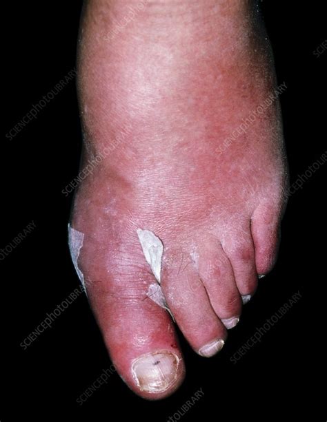 Cellulitis On The Toe Of A 75 Year Old Man Stock Image M1300360