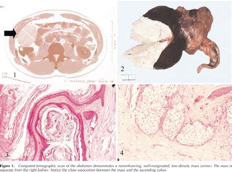 Figure From Dermoid Cyst Mature Cystic Teratoma Of The Cecum