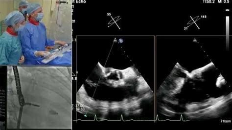 Tricuspid Valve Disease Guidelines And Beyond