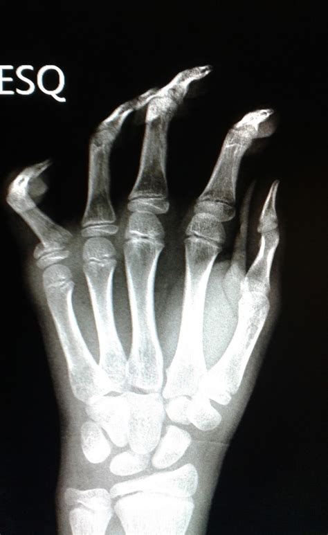 Dicas De Radiologia Radiografia Demonstrando Fratura Na Falange Proximal Do Quinto Dedo Da M O