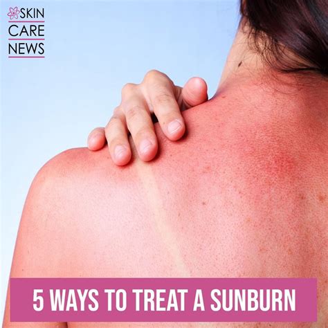 5 Ways To Treat A Sunburn Skin Care Top News