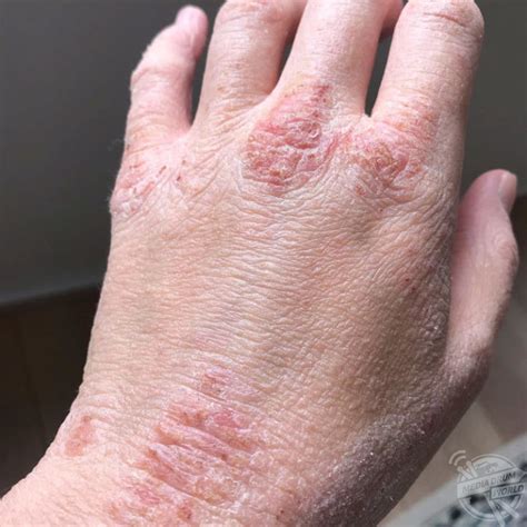 This Womans Severe Eczema Has People Worried Shes Contagious But It